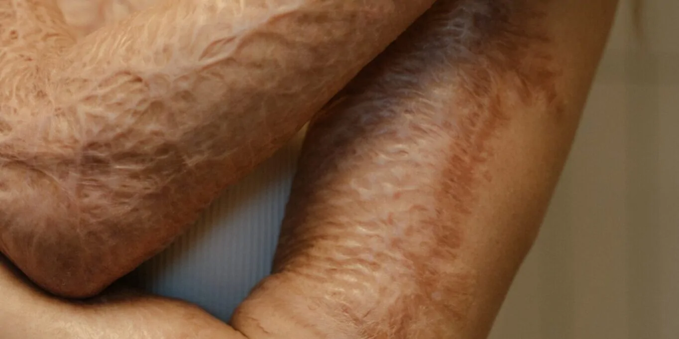 First Aid for Burns at Home: Immediate Actions and When to Seek Medical Help