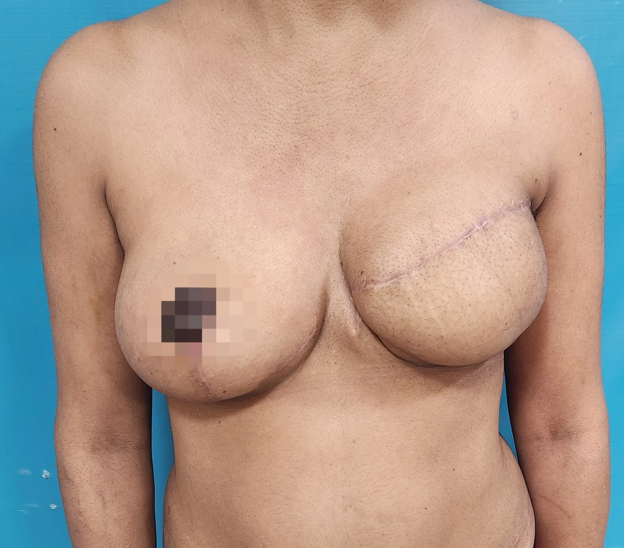 Breast Reconstruction — after