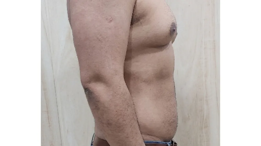 Liposuction — after