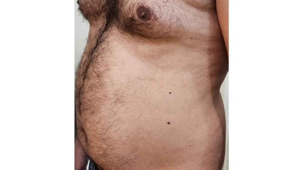 Liposuction — before