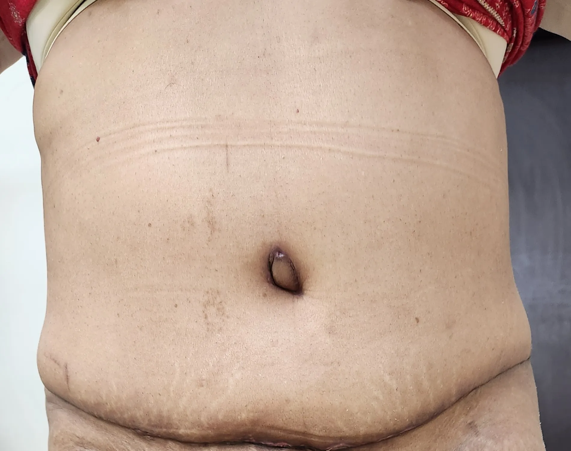 Tummy Tuck — after