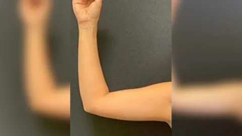 Arm Liposuction — before
