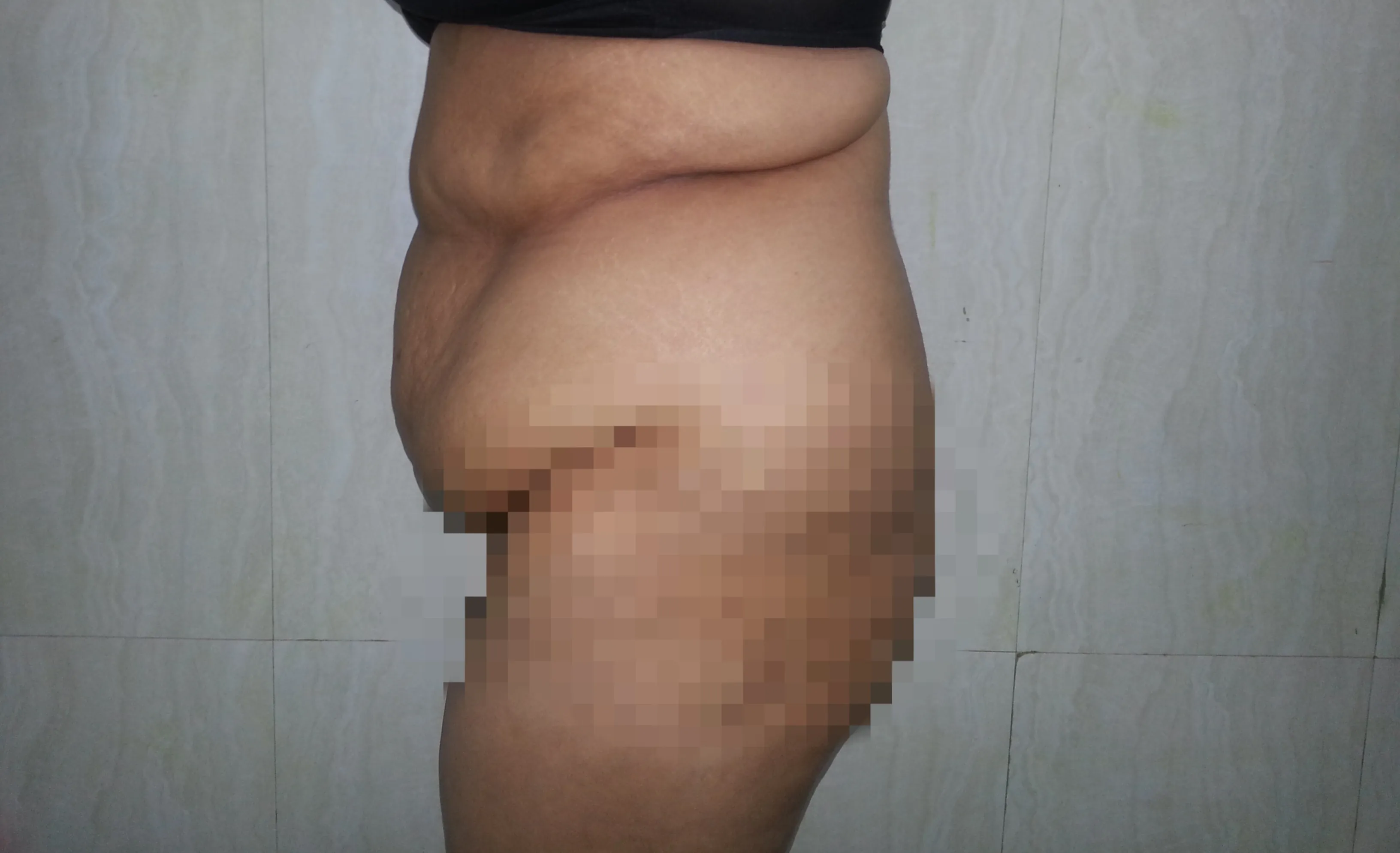 Lower Body Lift — before