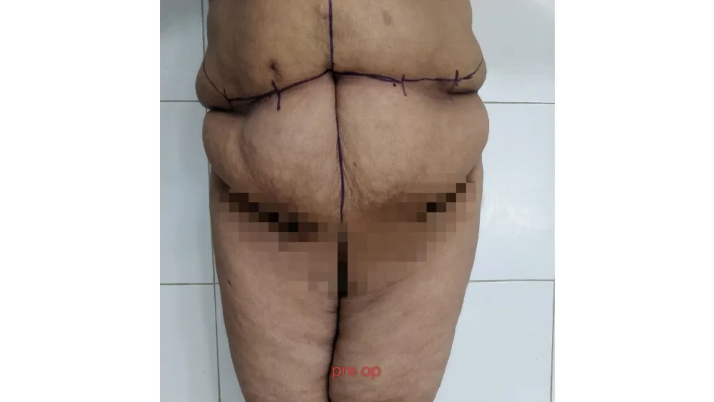 Lower Body Lift — before