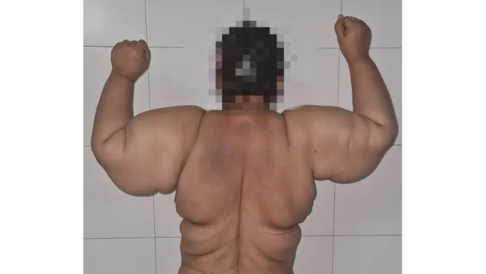 Upper Body Lift — before