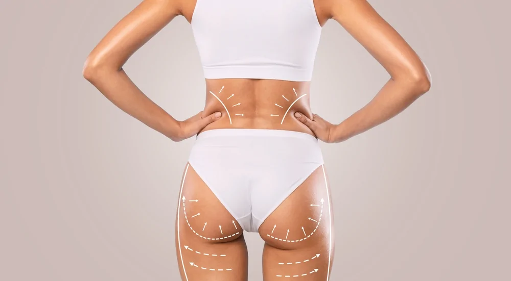 Liposuction of Buttocks and Thighs — hero image