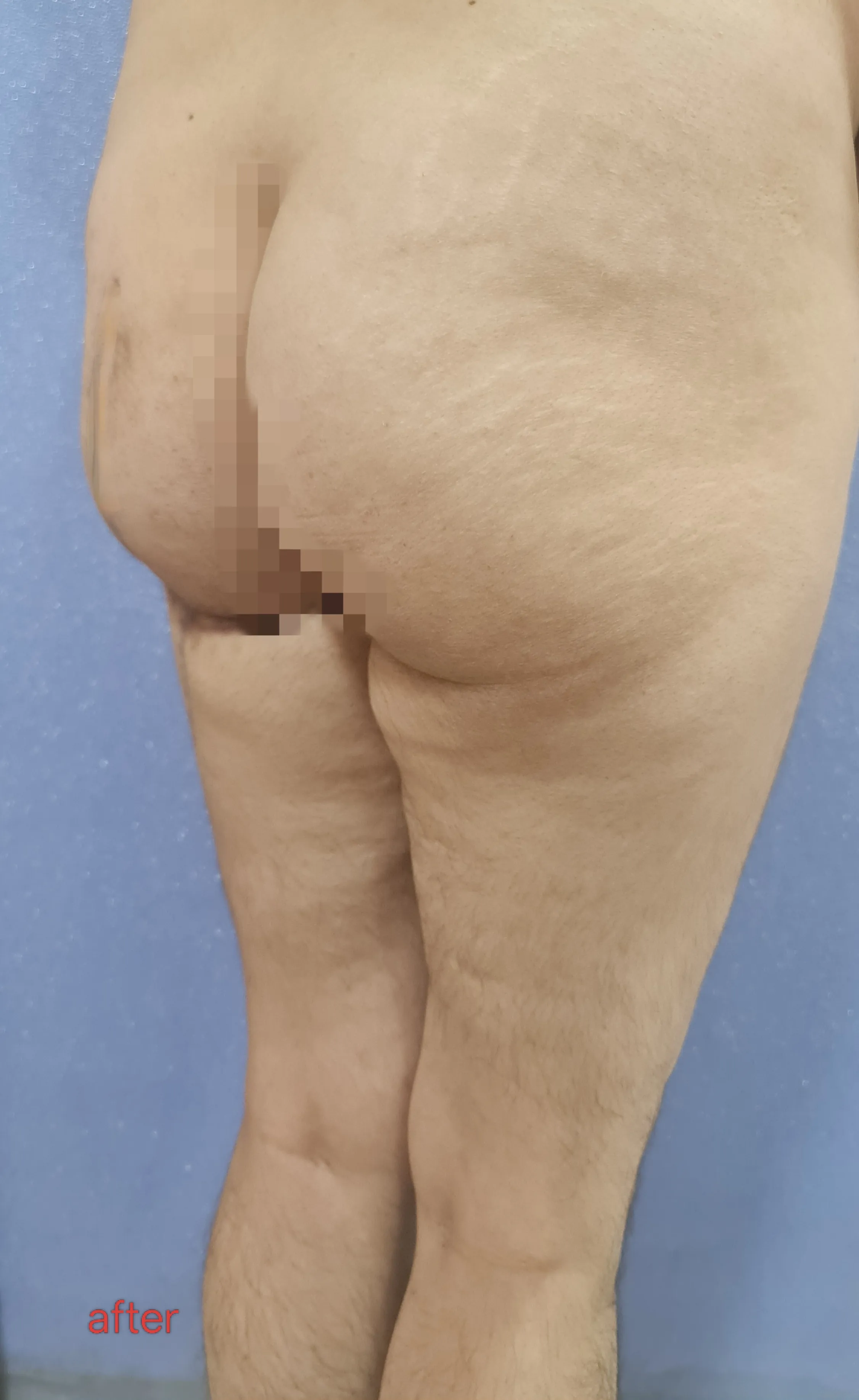Buttocks Thighs Liposuction — after