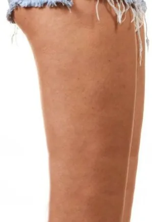 Medial Thigh Lift — after