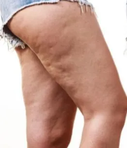 Medial Thigh Lift — before