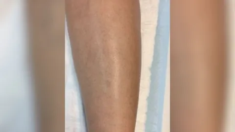 Spider Vein Treatment — after