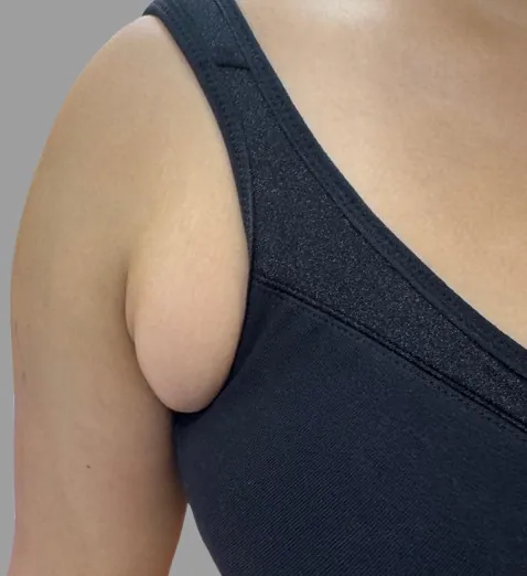 Axillary Breast — before