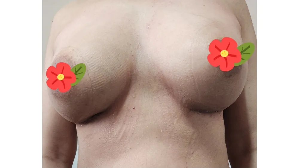 Breast Augmentation — after