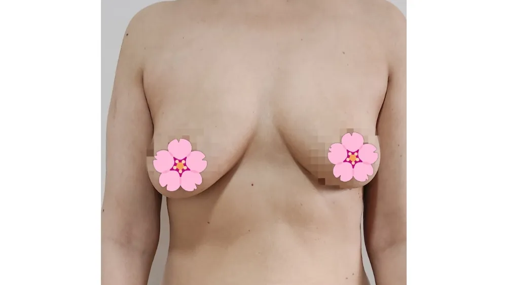 Breast Augmentation — before