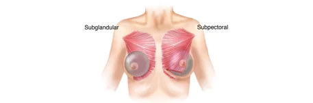 Breast Augmentation