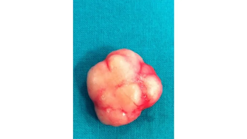 Breast Lump Removal — after