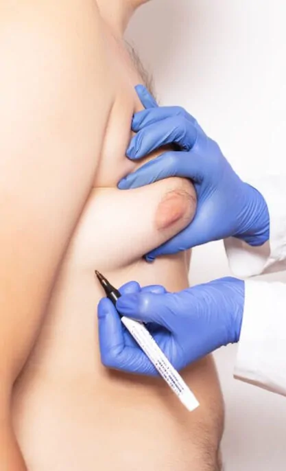 Gynecomastia