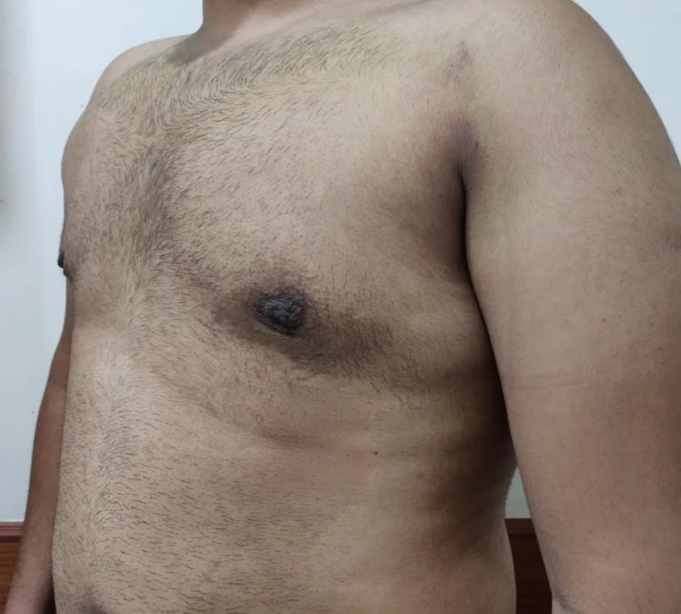 Gynecomastia — after