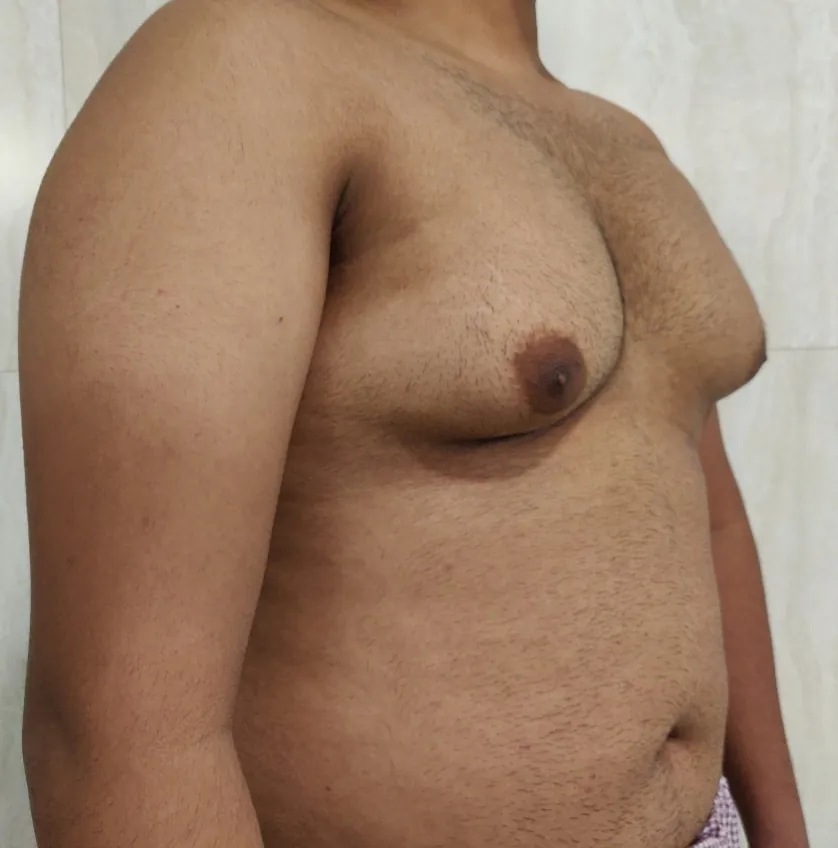 Gynecomastia — before