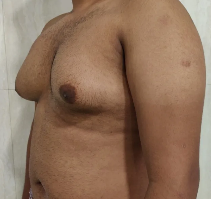 Gynecomastia — before