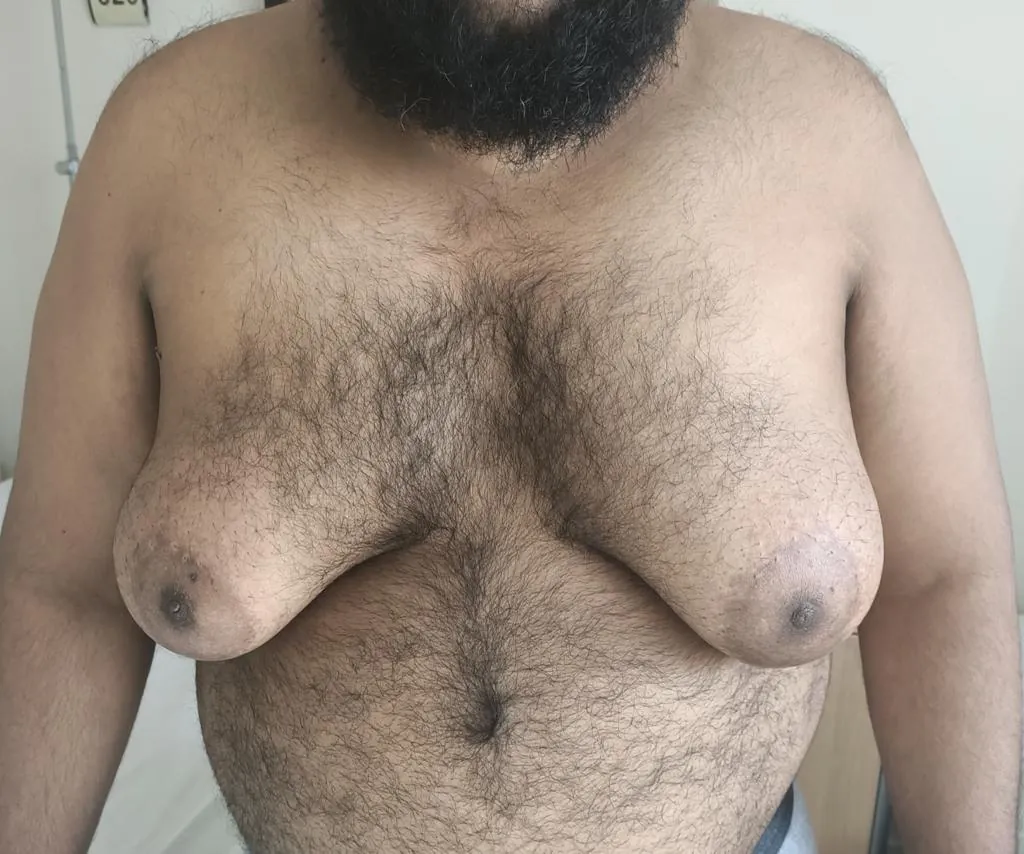 Gynecomastia — before