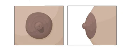 Nipple Deformities — after