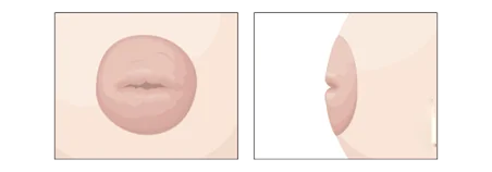 Nipple Deformities — before