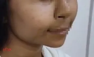 Cheek Augmentation — after