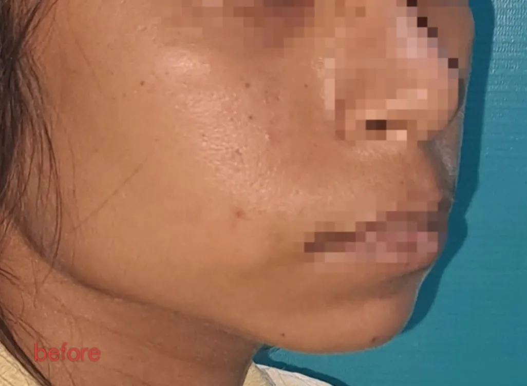 Cheek Augmentation — before