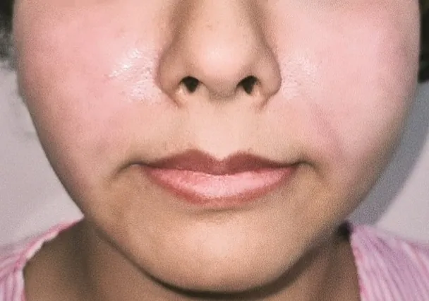 Cheek Augmentation — after
