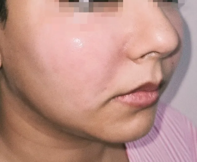 Cheek Augmentation — after