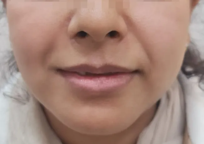 Cheek Augmentation — before