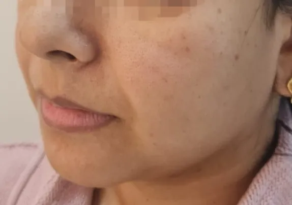 Cheek Augmentation — before