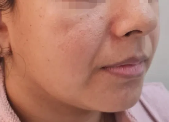 Cheek Augmentation — before