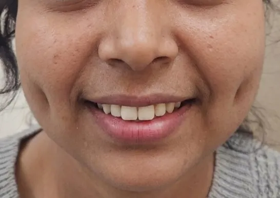 Dimple Creation — after