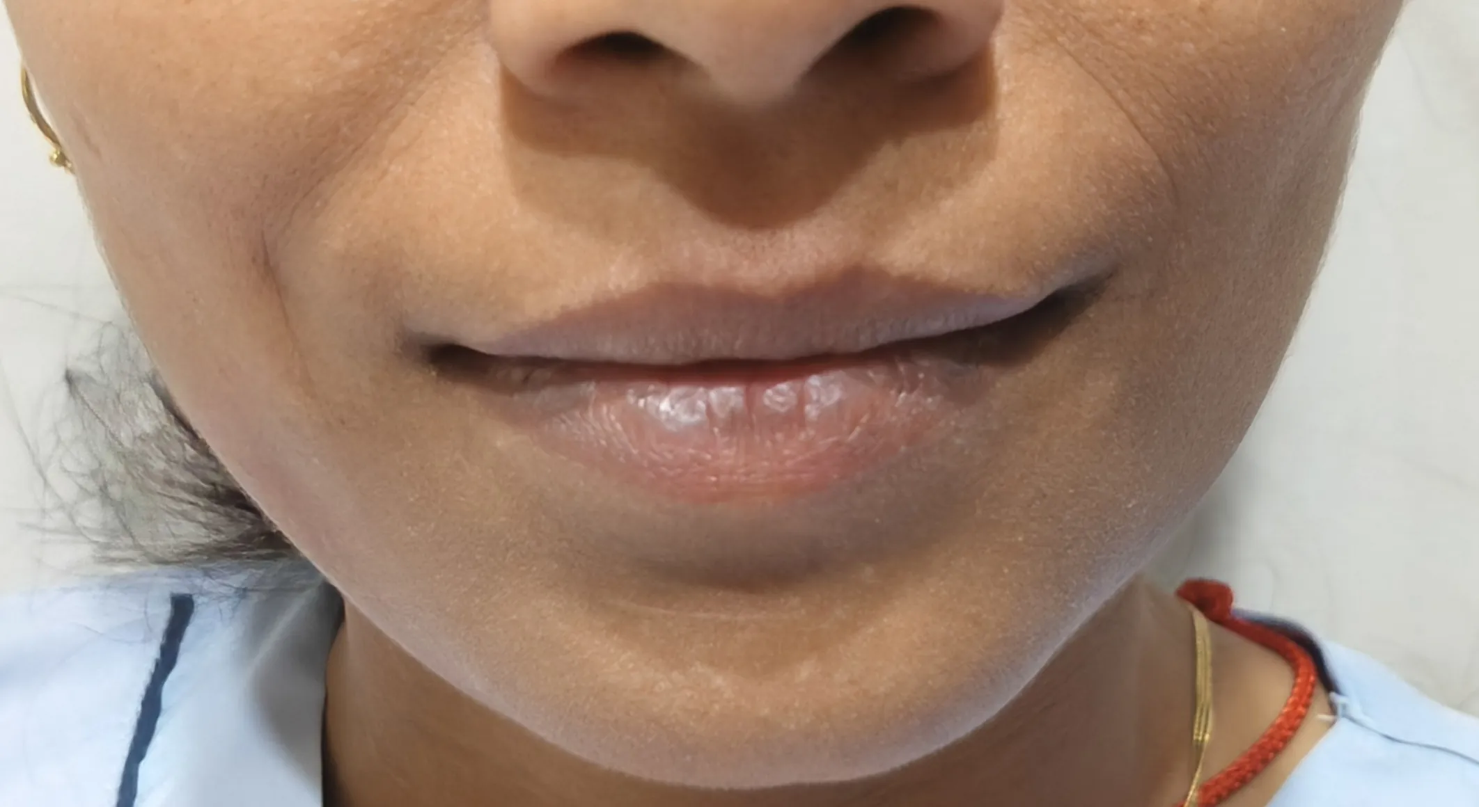 Dimple Creation — before