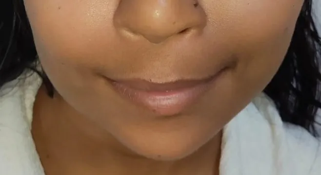 Chin Augmentation — after