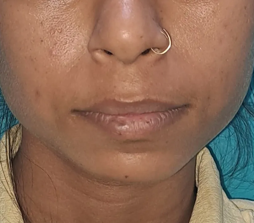 Chin Augmentation — before
