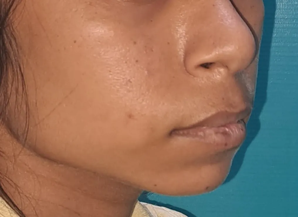 Chin Augmentation — before