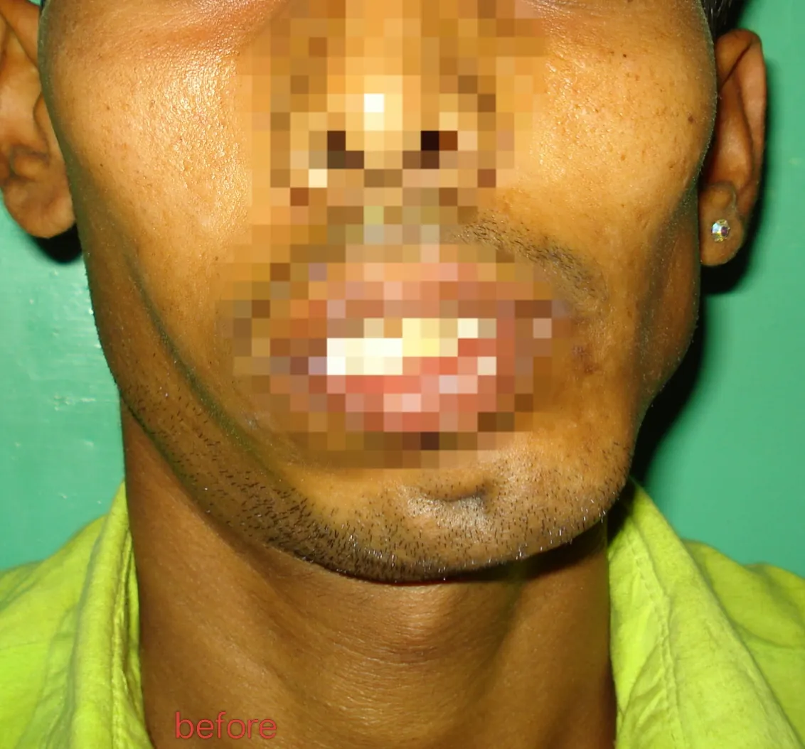 Chin Augmentation — before