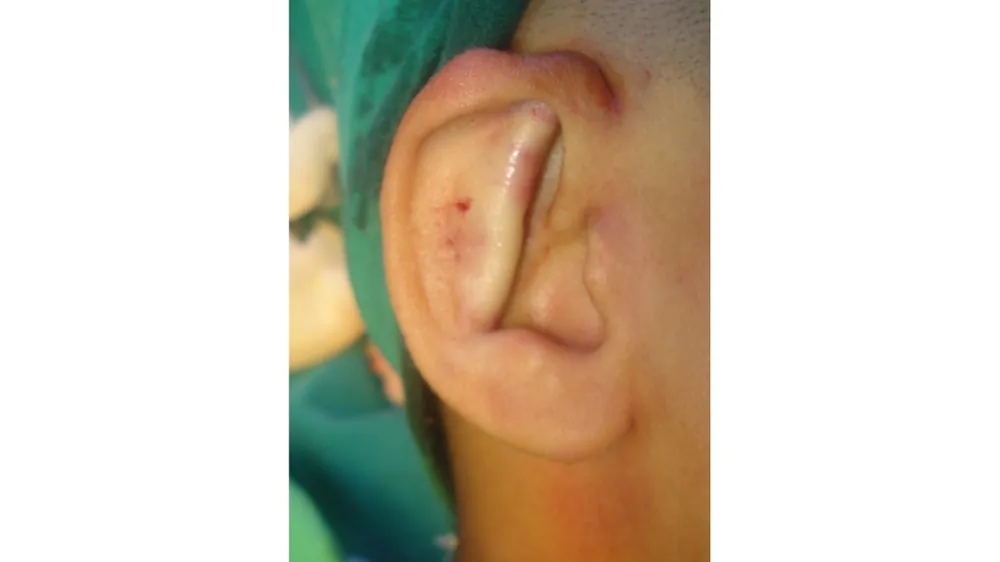 Ear Correction Surgery — after