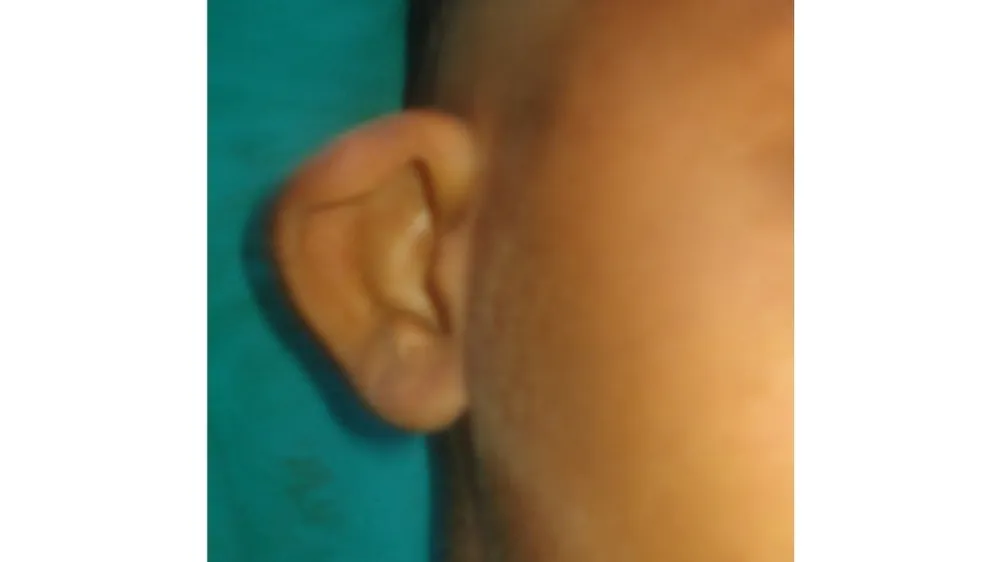 Ear Correction Surgery — before