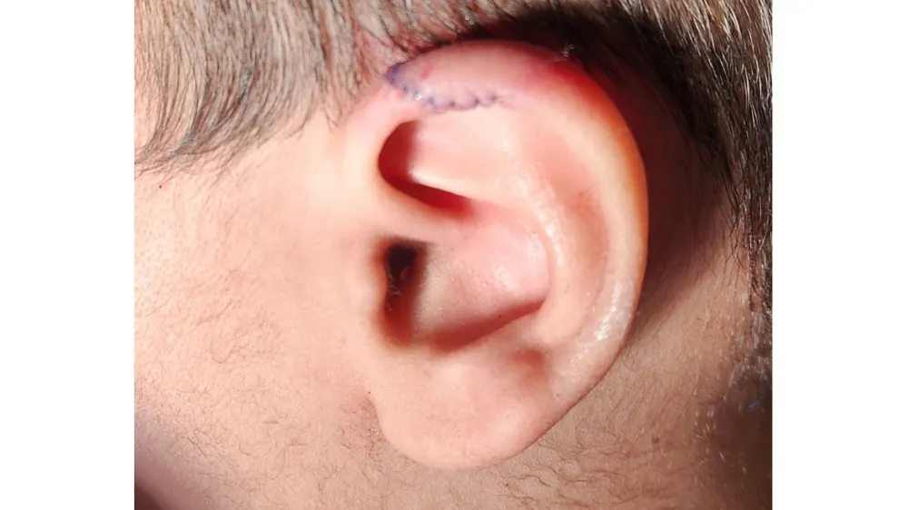 Ear Correction Surgery — after