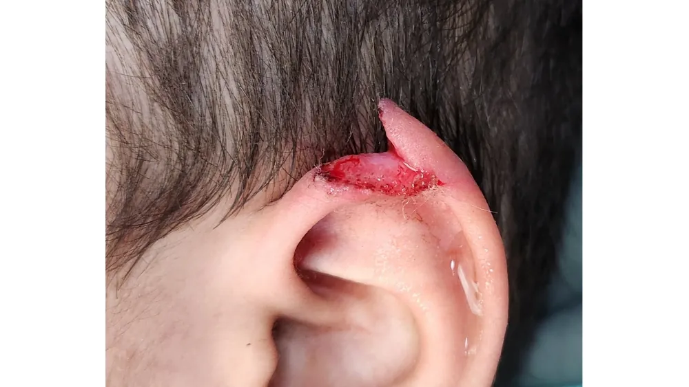 Ear Correction Surgery — before