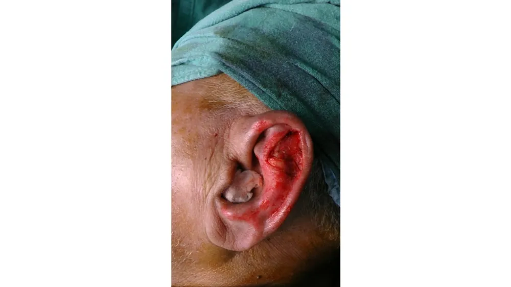 Ear Correction Surgery — before