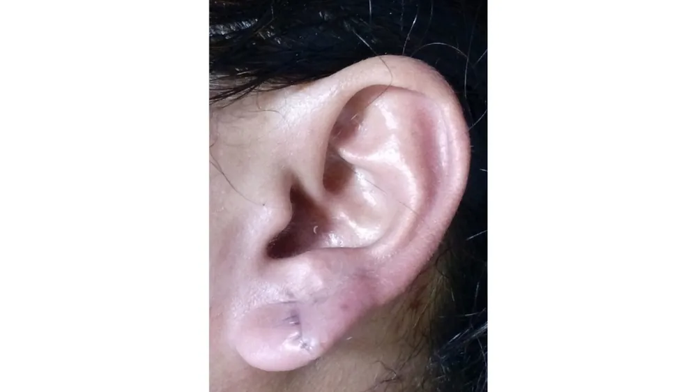 Ear Lobe Repair — after