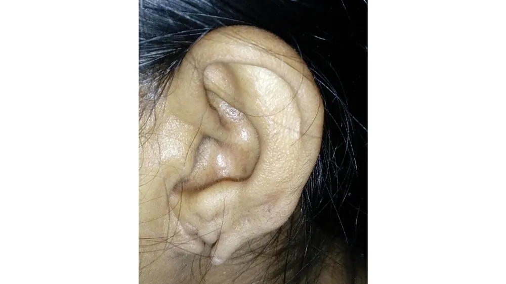 Ear Lobe Repair — before