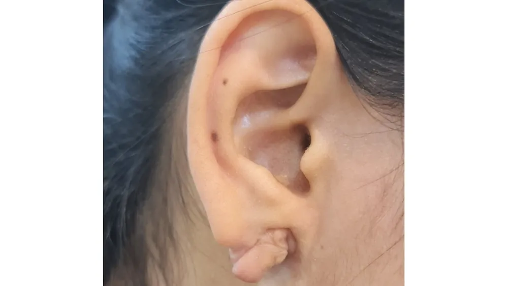Ear Lobe Repair — before