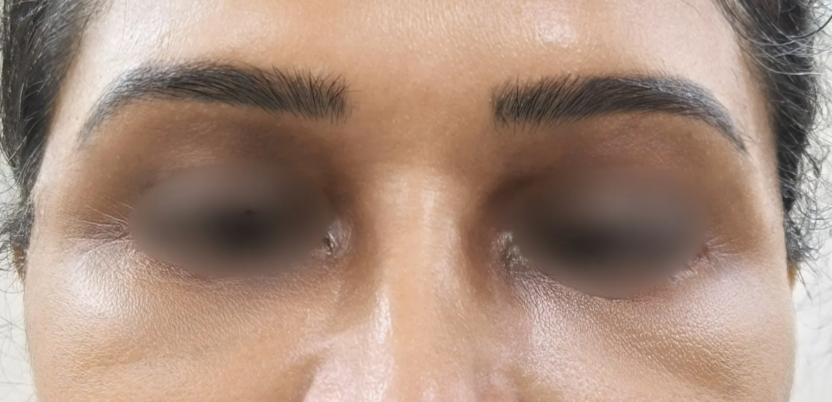Blepharoplasty — after