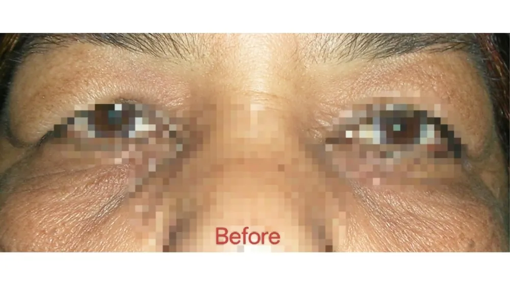 Blepharoplasty — before
