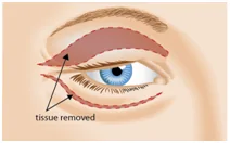 Blepharoplasty – Eyelid Surgery — patient outcome